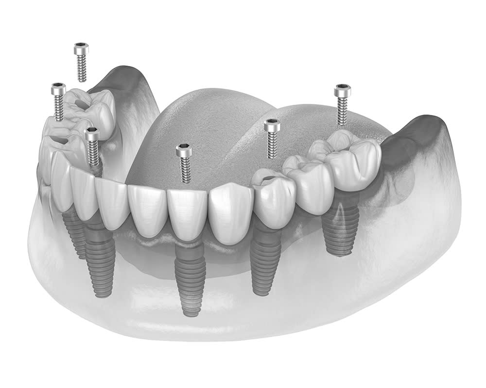 Perte de toutes les dents