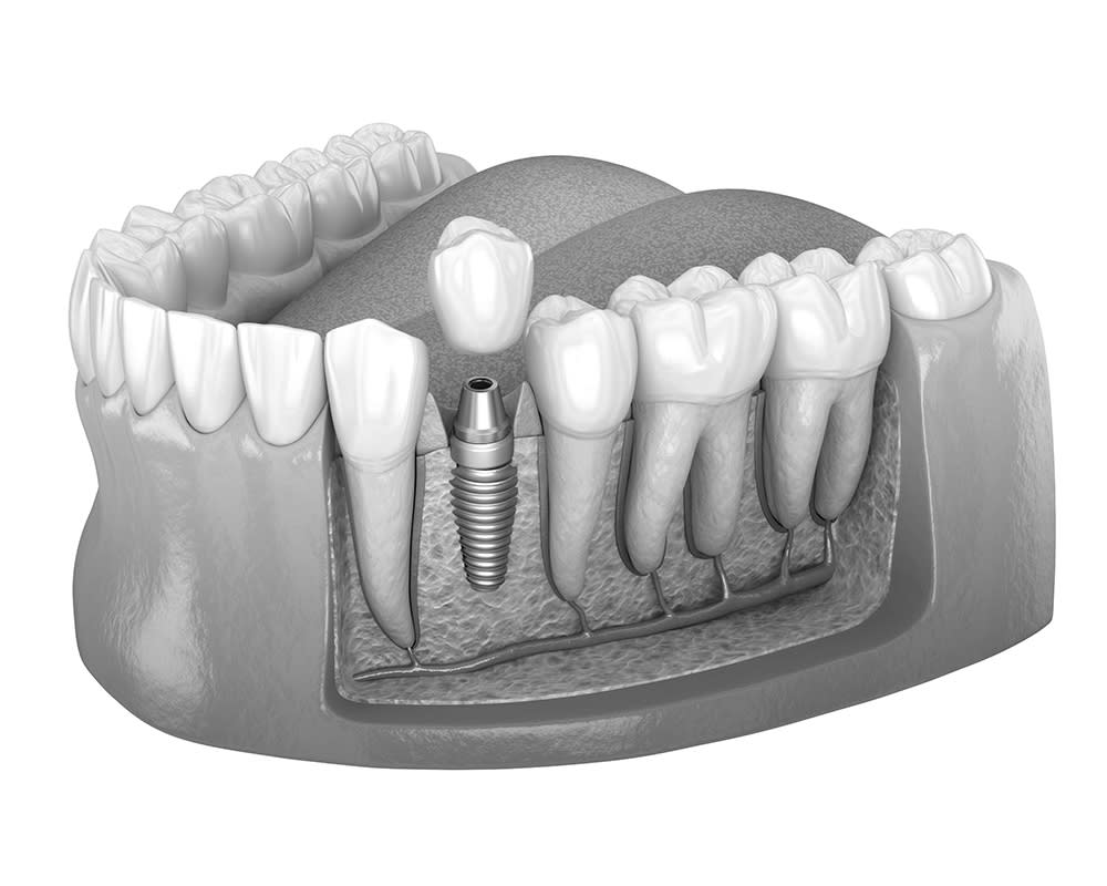 Perte d’une ou plusieurs dents