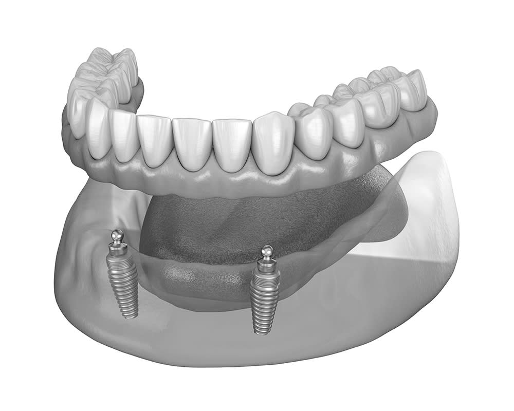 Prothèses stabilisées par implants